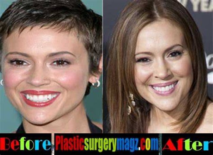Alyssa Milano Plastic Surgery Before and After Botox Injections