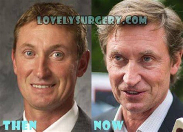 wayne gretzky plastic surgery